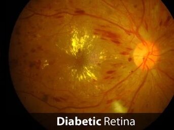 Diabetic Retinopathy